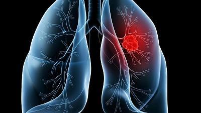 中国首个二代肺癌靶向药获批 竞争加剧引发药企